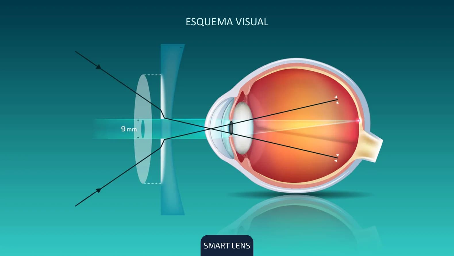 Esquema visual: la luz que pasa por la periferia del cristal MyoFix se enfoca por delante de la retina.