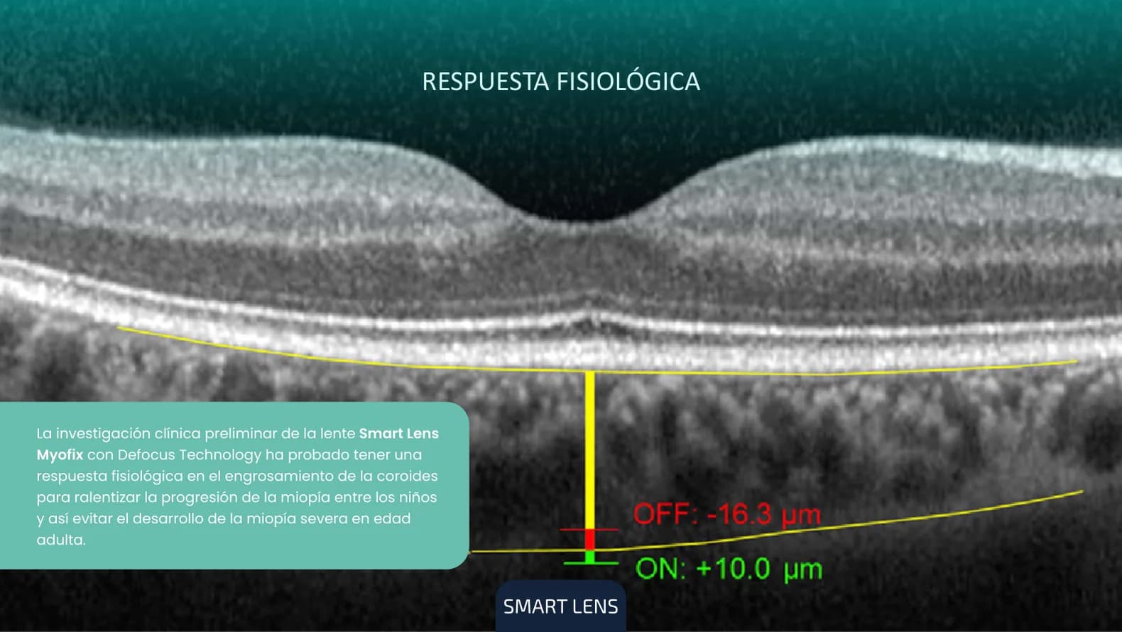 Tomografía de coroides: la investigación clínica preliminar de MyoFix mostró engrosamiento de la coroides, más 10 micrones con el cristal frente a menos 16,3 sin él.