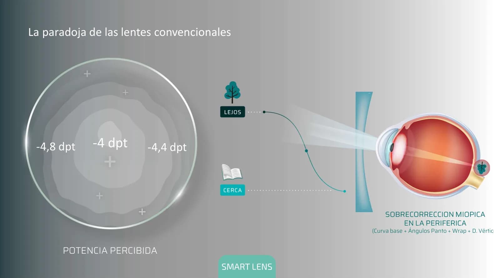 La paradoja de las lentes convencionales: hacia la periferia la potencia percibida sube a -4,4 y -4,8 dioptrías, una sobrecorrección miópica.